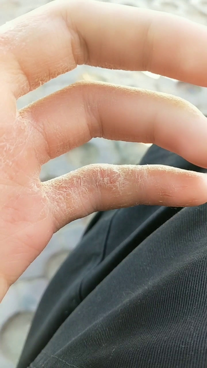 手成了这样咋回事我现在只有手指头一动就疼?