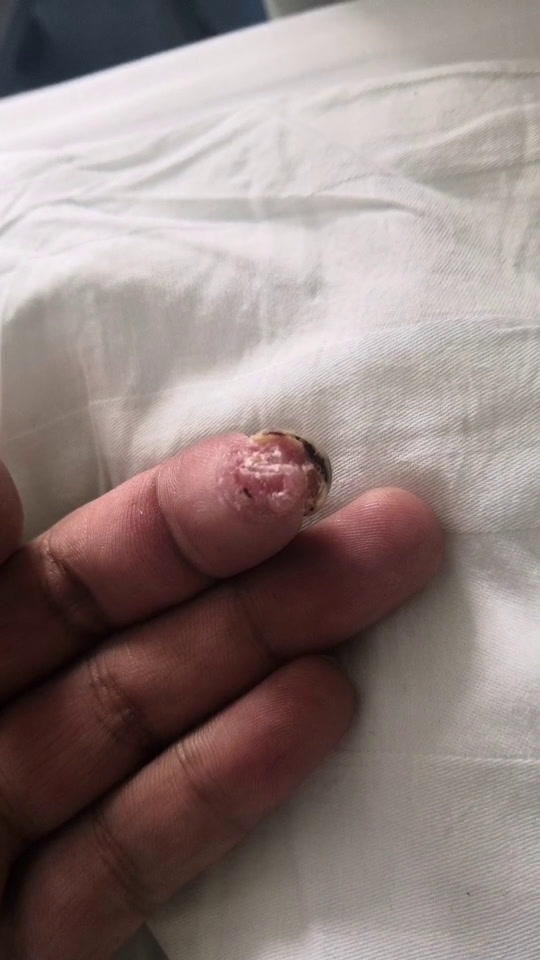工伤导致左手中指,指端一块肉缺失?