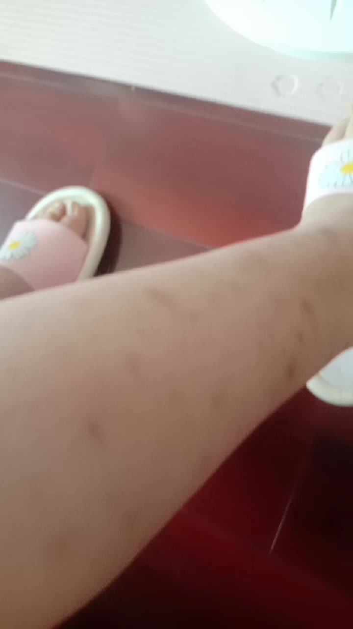 搞不懂为什么我的腿上有那么多包的印记,有两个是骑电动车摔的?