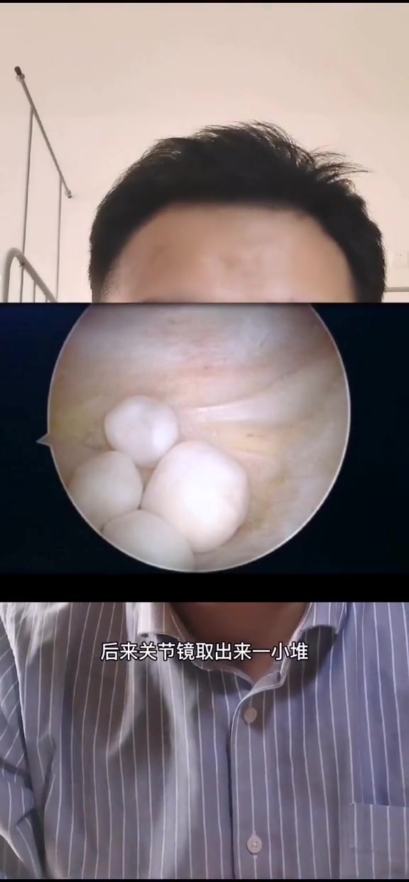 耳石症和美尼尔症是同一种病吗?